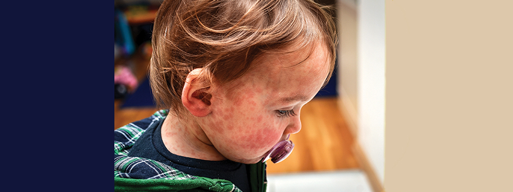 Measles on child